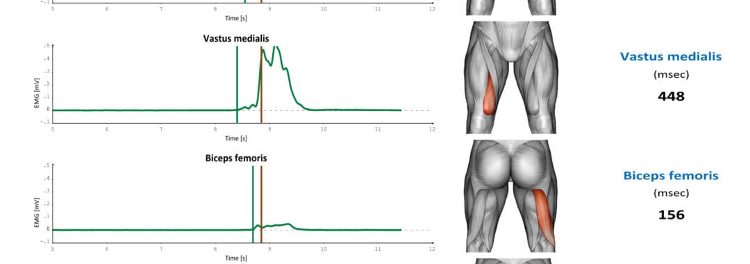 ACL injury risk assessment using EMG of the quadriceps and hamstrings