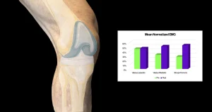 A leg exercising with a knee replacement showing EMG values