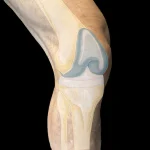 An exercising leg showing a knee replacement.